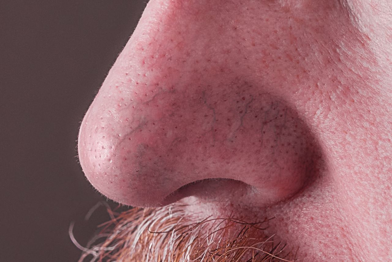 Rosacea al naso