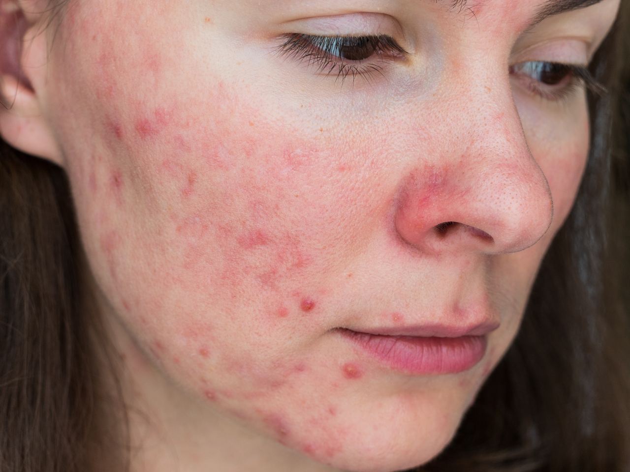 Rosacea del viso - pustole